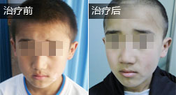 陈思源白癜风恢复案例