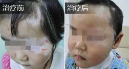 楚梦瑶白癜风恢复案例