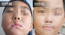 刘文博白癜风恢复案例