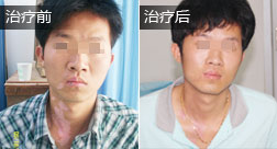 陈梦华白癜风恢复案例