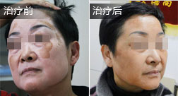 廖女士白癜风恢复案例