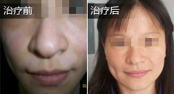 何菲白癜风恢复案例