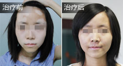 刘蓉白癜风恢复病例