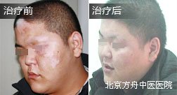 方小龙白癜风恢复案例