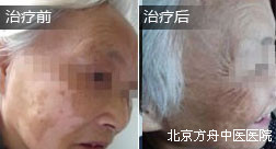 李某脸部白癜风恢复案例