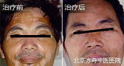杨某面部白癜风恢复案例