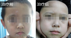 苏博文白癜风恢复案例