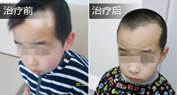 孙继堂白癜风恢复案例