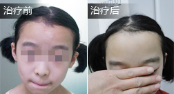 武文璇白癜风恢复案例