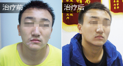 刘刚白癜风恢复案例