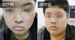 李钰汉白癜风恢复案例