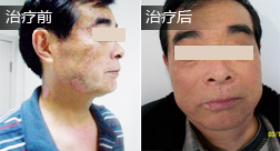 马某白癜风恢复案例