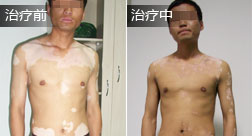 皮立国白癜风恢复案例