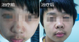 宋健白癜风恢复案例